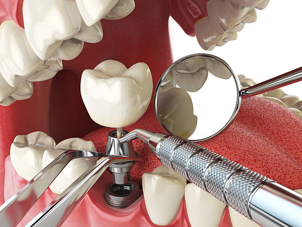 Best Emergency Tooth Extraction in Ridge, NY